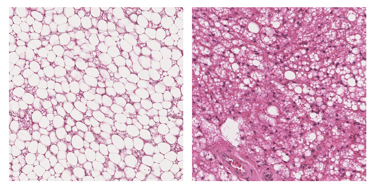 Le tissu adipeux brun des souris n’exprimant pas les enzymes ATGL et HSL (panel de gauche) est plus chargé en graisses que celui des souris exprimant ATGL et HSL (à droite). Crédit : I2MC, 2024.